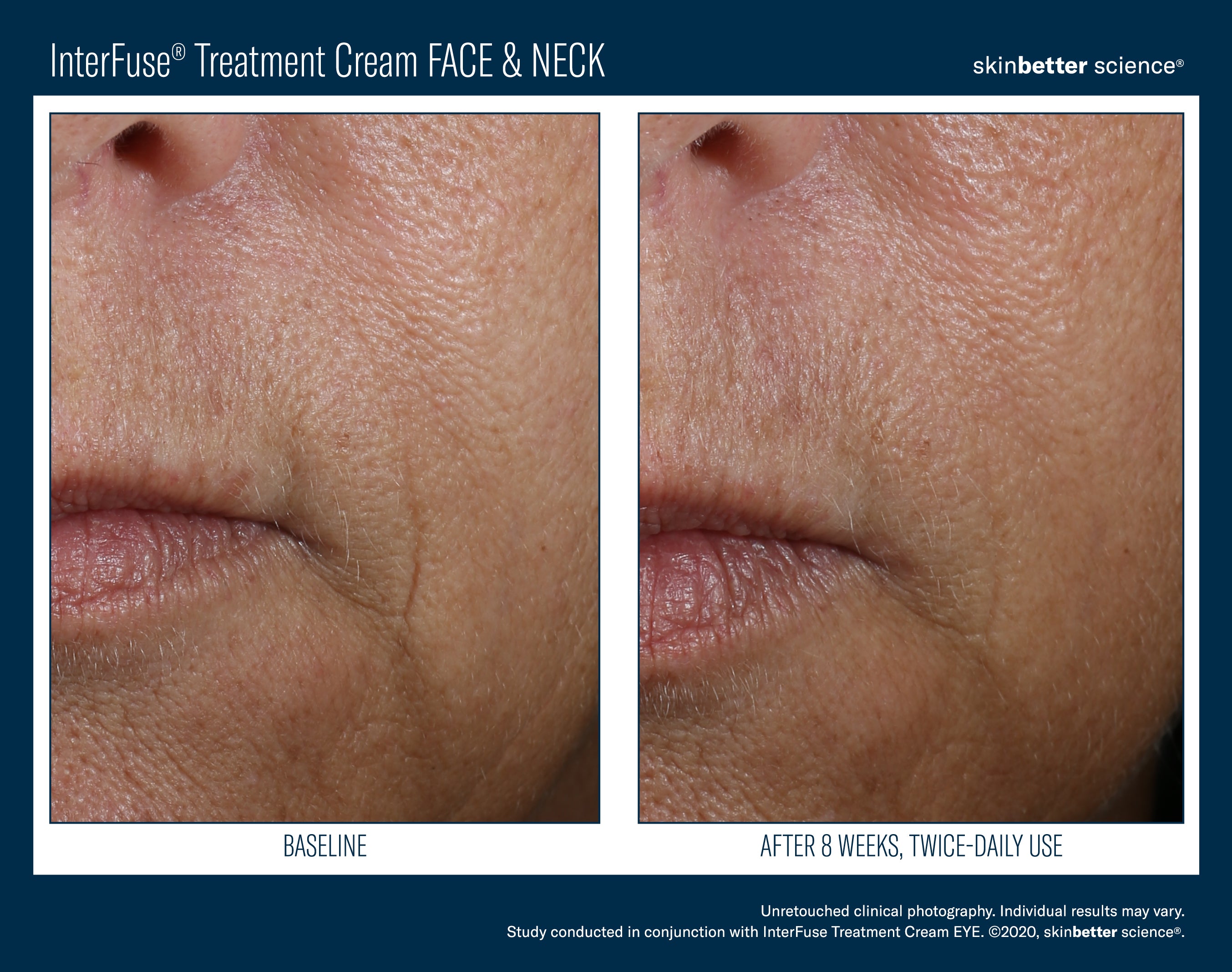Interfuse treatment face and Neck SkinBetter Science