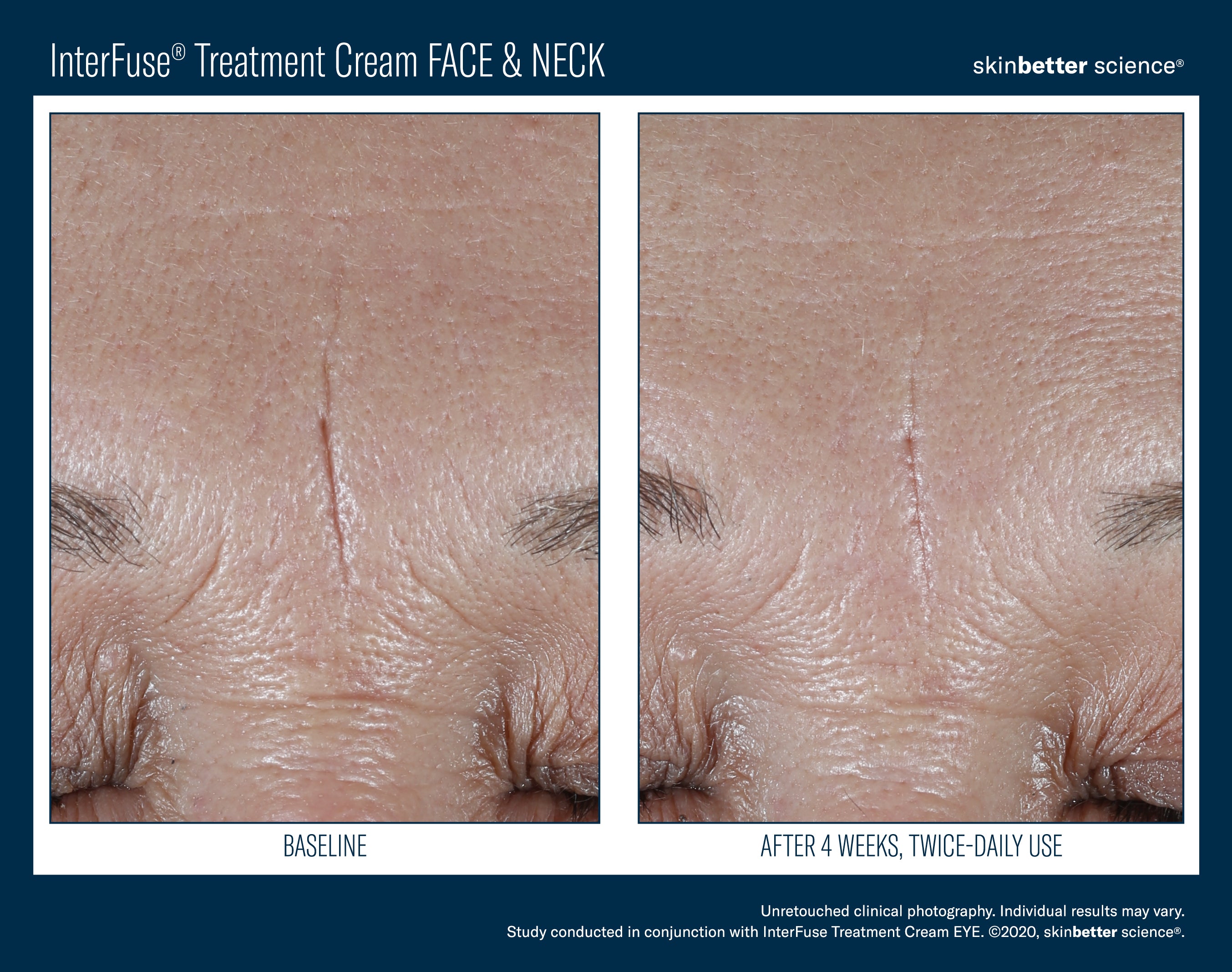 Interfuse treatment face and Neck SkinBetter Science
