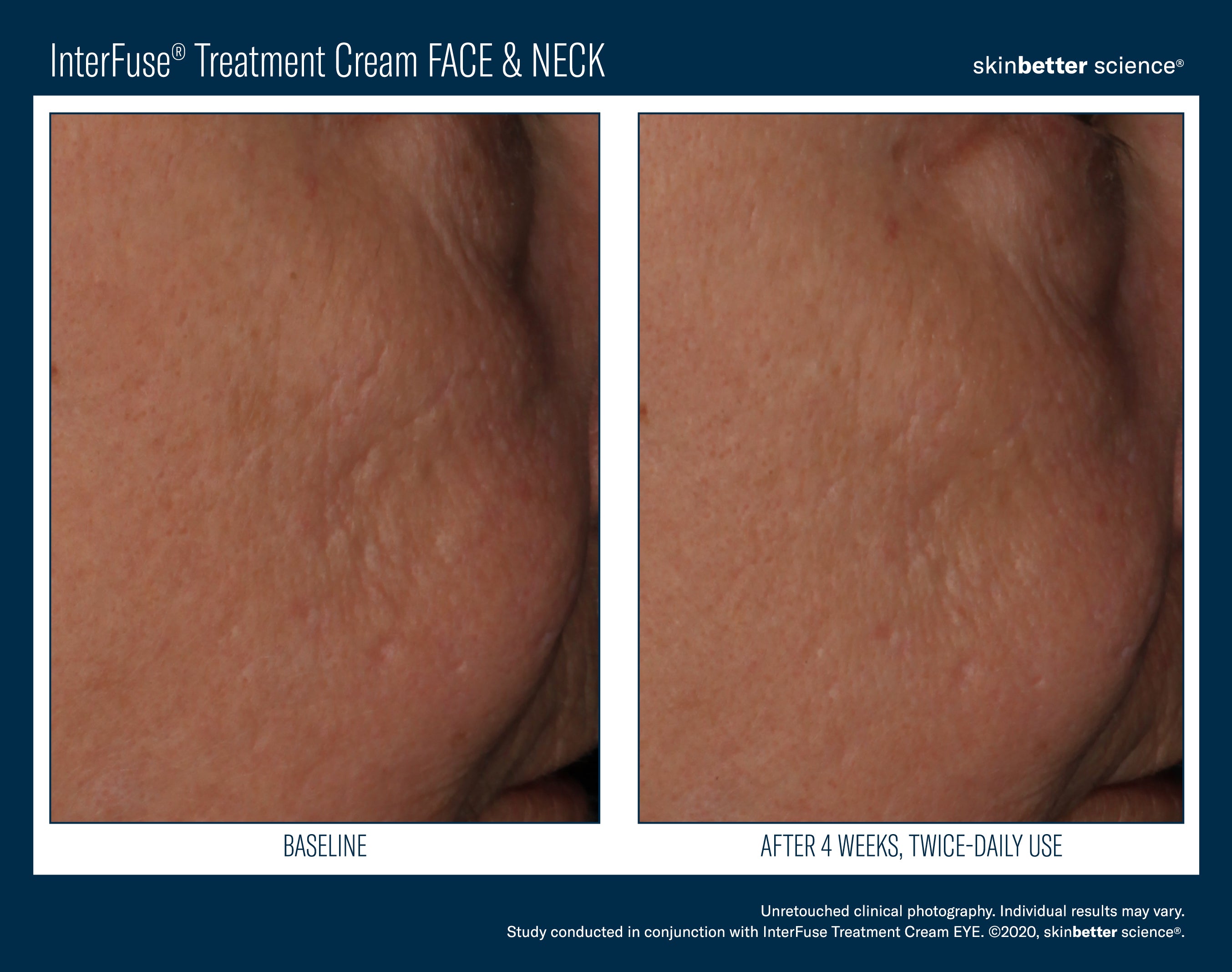 Interfuse treatment face and Neck SkinBetter Science