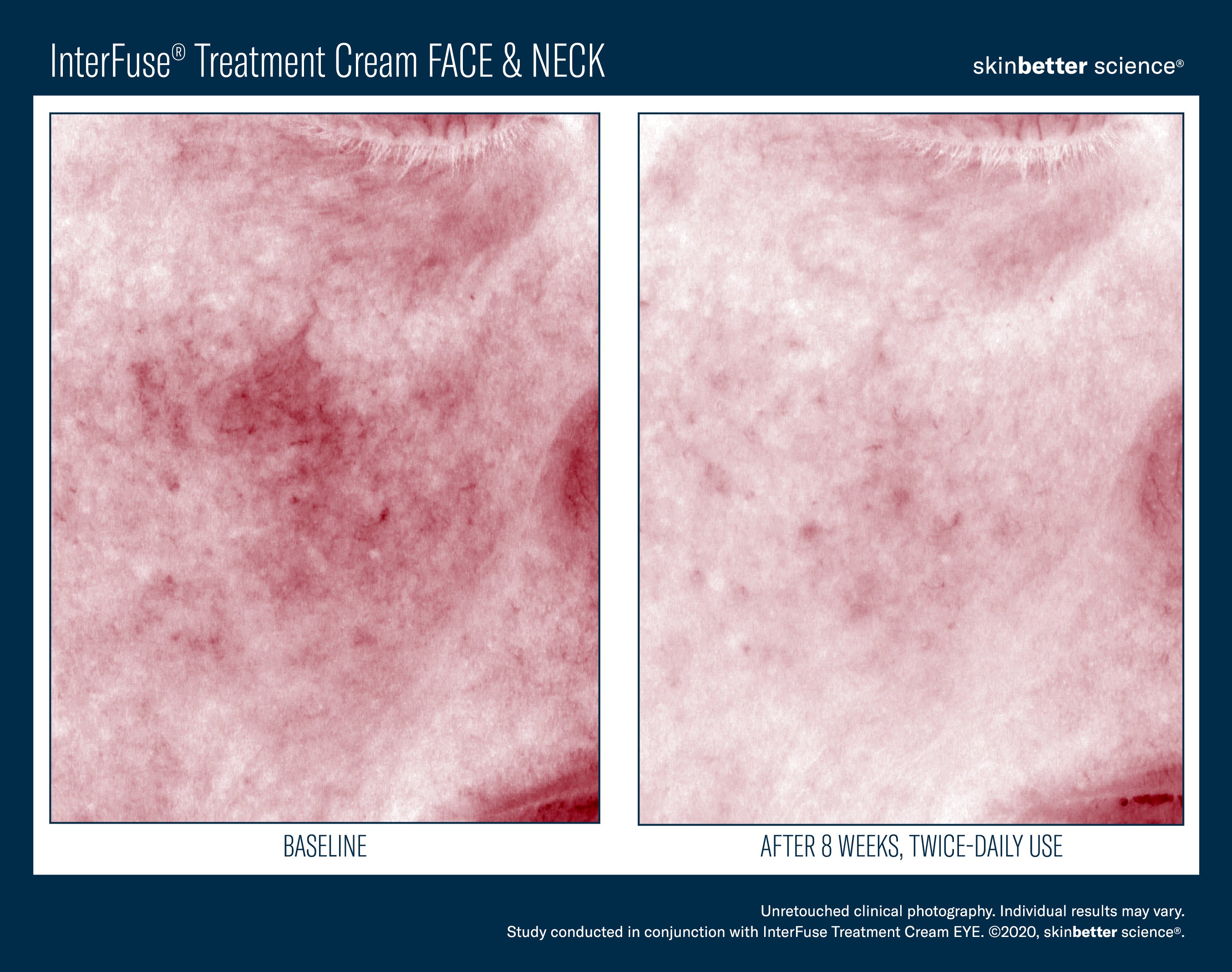 Interfuse treatment face and Neck SkinBetter Science