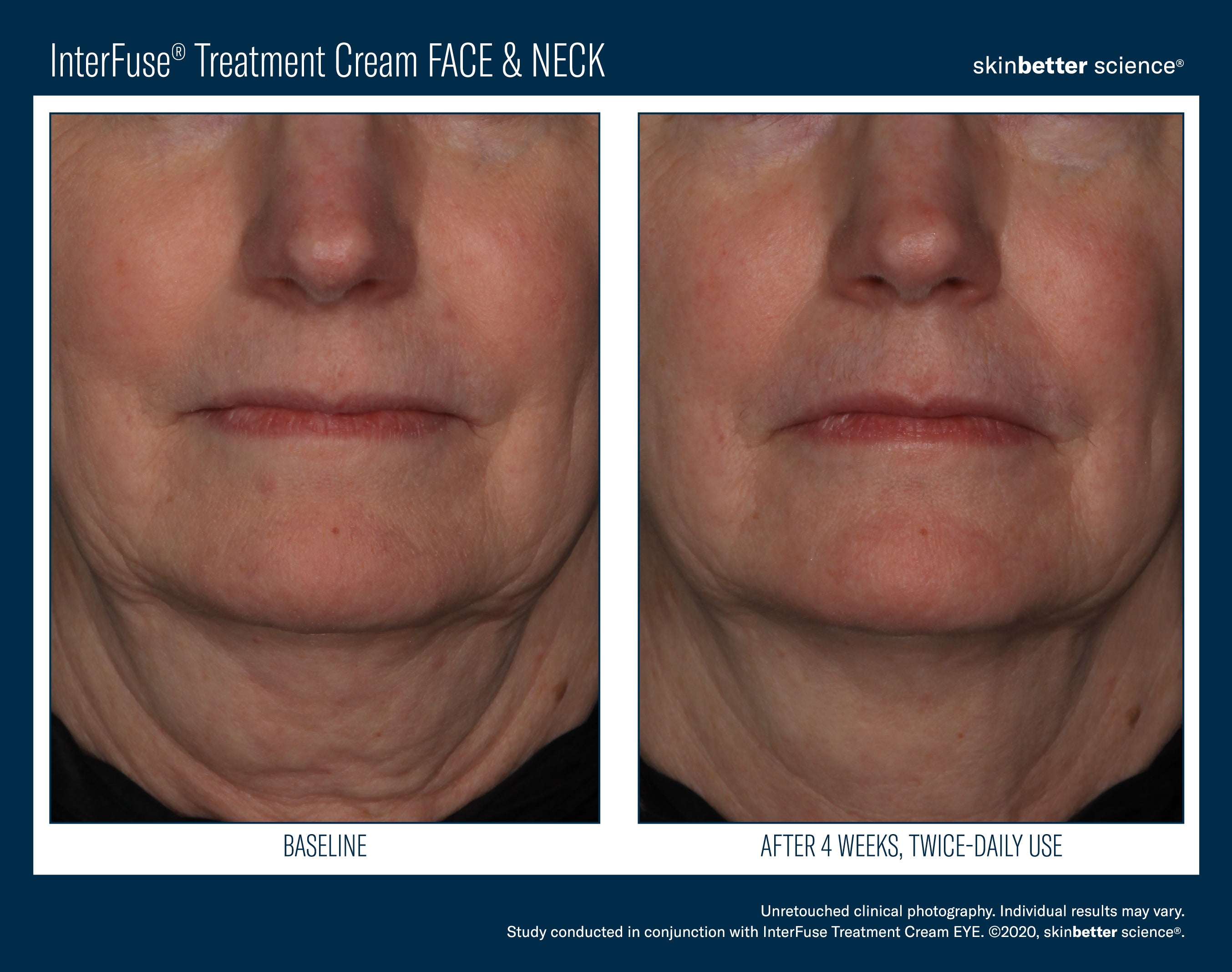 Interfuse treatment face and Neck SkinBetter Science